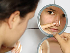 Acne – how to get rid of it